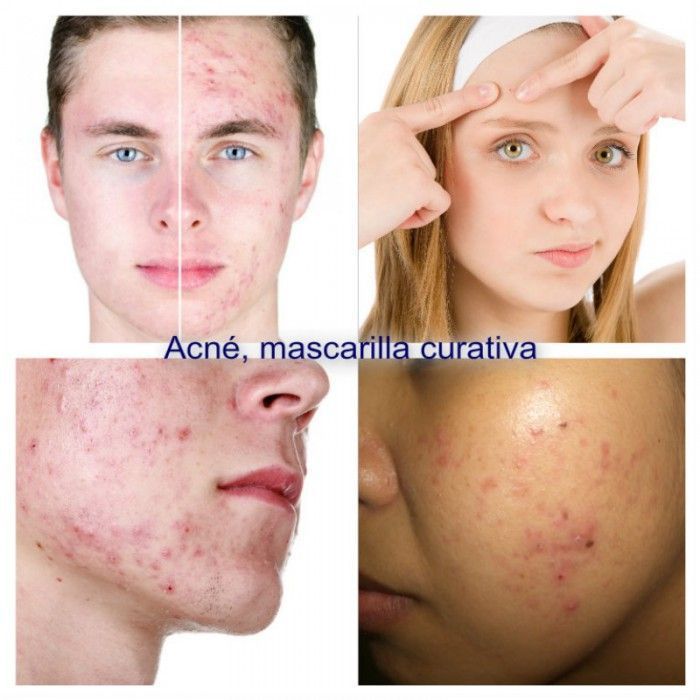Collage Acne_01 (Copiar)