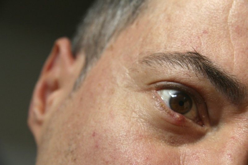 Orzuelos en los Ojos, remedios naturales