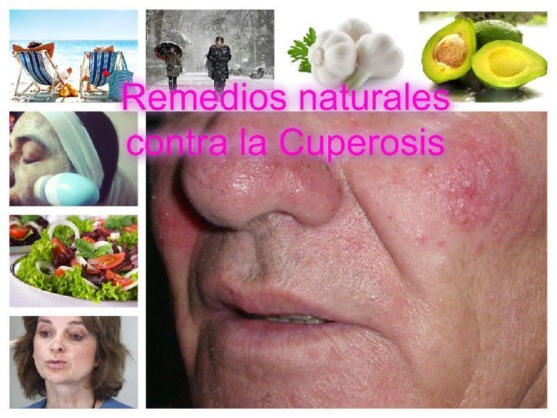 Remedios naturales contra las venas rojas de la cara ó Cuperosis