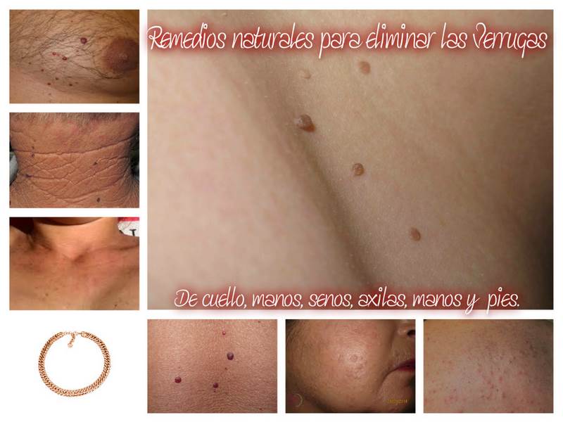 Collage Verrugas_ CSBN_red