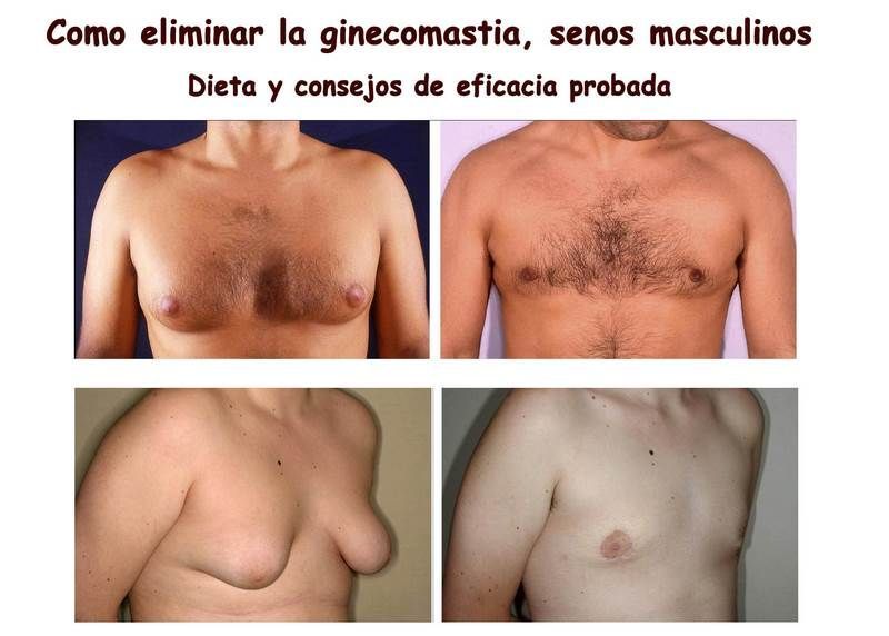 Collage Ginecomastia (Copiar)